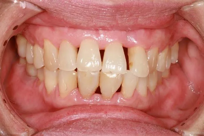 بیماری پریودنتال (لثه)