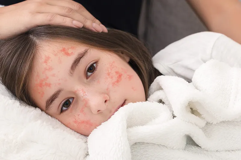 سرخک (Measles)