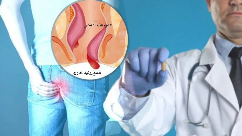 هموروئید (بواسیر)