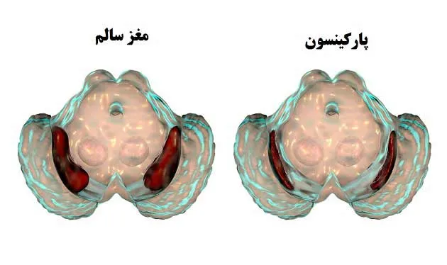 بیماری پارکینسون (Parkinson's Disease)
